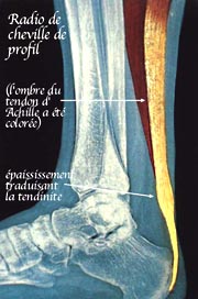 Tendon d achille Centre Orthop dique Pasteur Lanroze